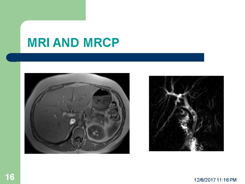 MRI AND MRCP 12/8/2017 11:16 PM 16